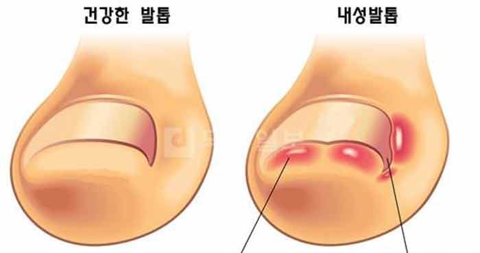 내성발톱