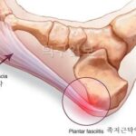 족저근막염