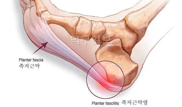 족저근막염